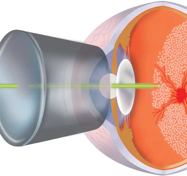 Fotocoagulación Retiniana