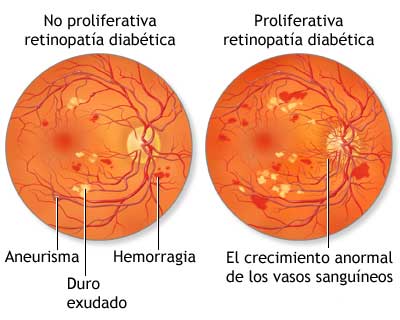 Retinopatía Diabética