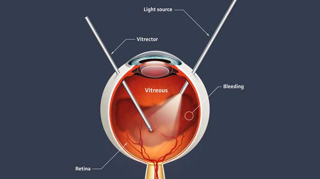 Vitrectomía