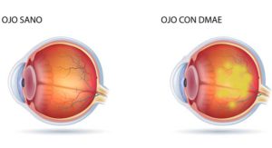 Degeneraci N Macular Asociada A La Edad Grupo Oftalmol Gico