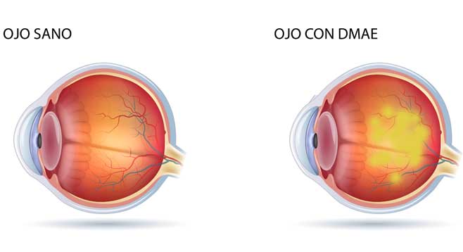 Degeneración Ocular Asociada a la Edad