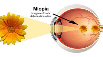 Miopía - Cirugía Láser Refractiva