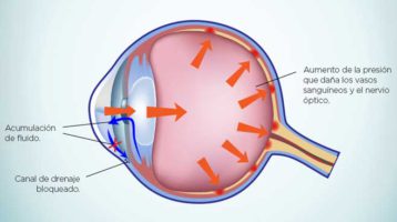 Síntomas del Glaucoma